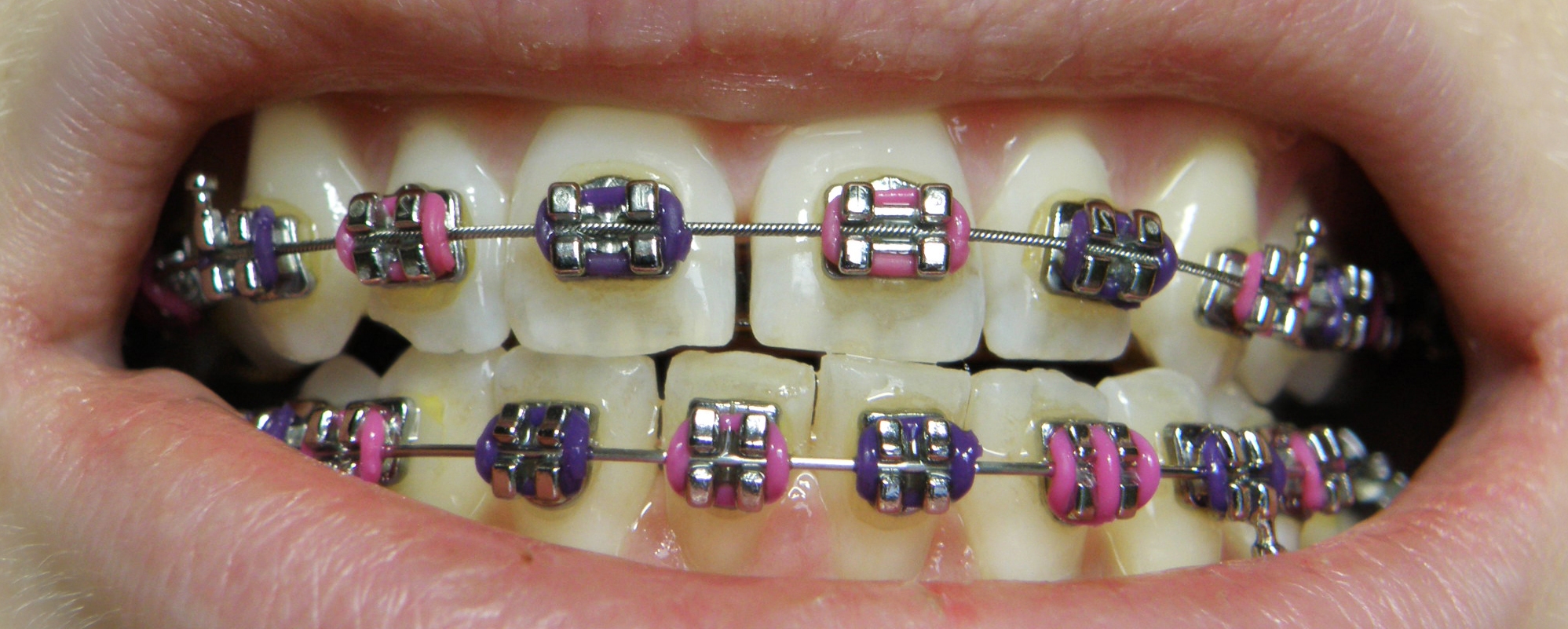 bad teeth